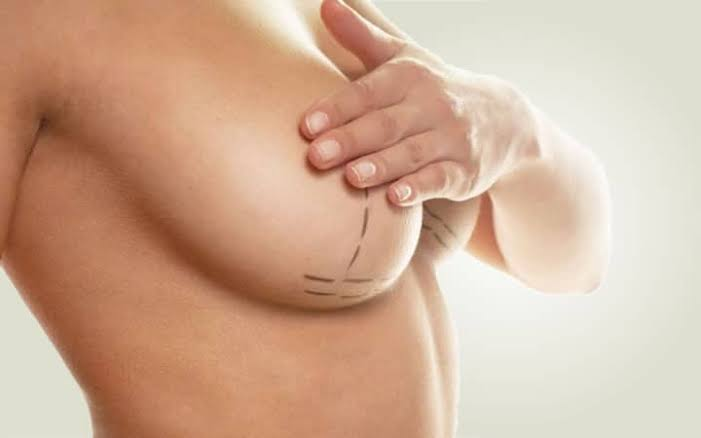 Mamoplastia Redutora